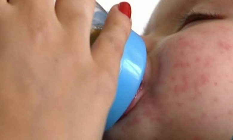 تسجيل 96 حالة إصابة بالحصبة في النمسا العليا هذا العام وأطباء يحذرون من التفشي ويطالبون بتطعيم الأطفال تسجيل 96 حالة إصابة بالحصبة في النمسا العليا هذا العام وأطباء يحذرون من التفشي ويطالبون بتطعيم الأطفال