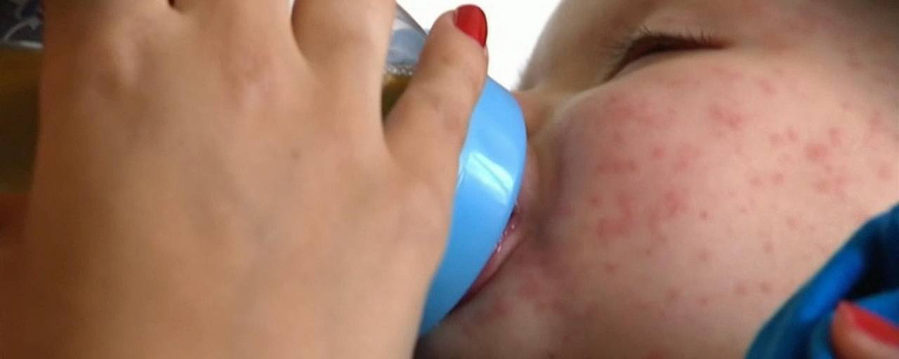 تسجيل 96 حالة إصابة بالحصبة في النمسا العليا هذا العام وأطباء يحذرون من التفشي ويطالبون بتطعيم الأطفال